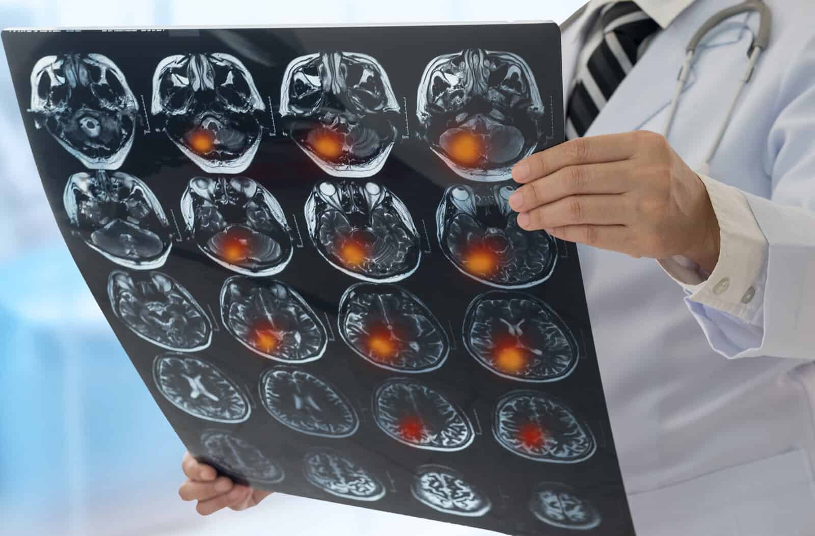 brain-tumor-doctor-examines-the-mri-scan-brain-x-ray-image-of-the-patient