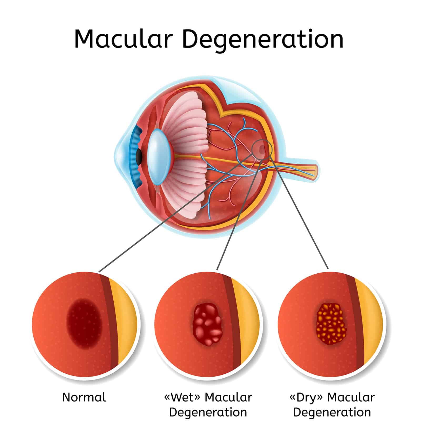 Macular Degeneration Resources Staying Alive