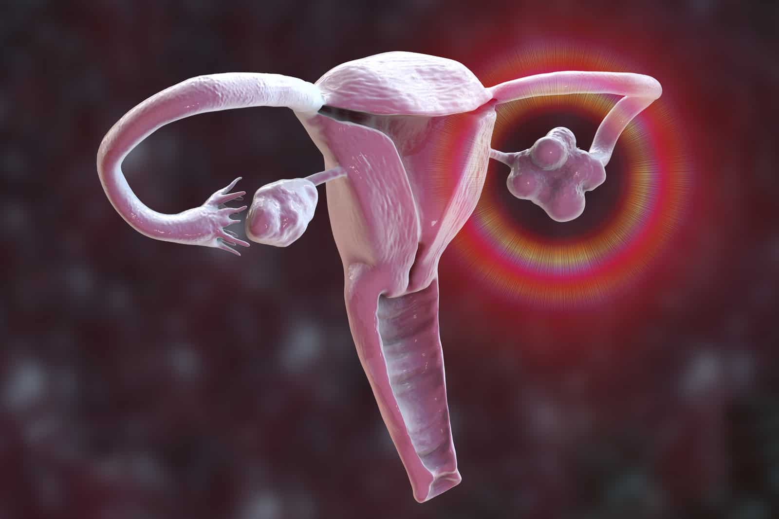 polycystic-ovary-syndrome-3d-illustration-showing-healthy-ovary-right-and-enlarged-ovary-with-cysts-left
